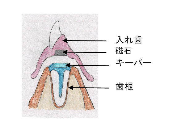 磁性アタッチメント